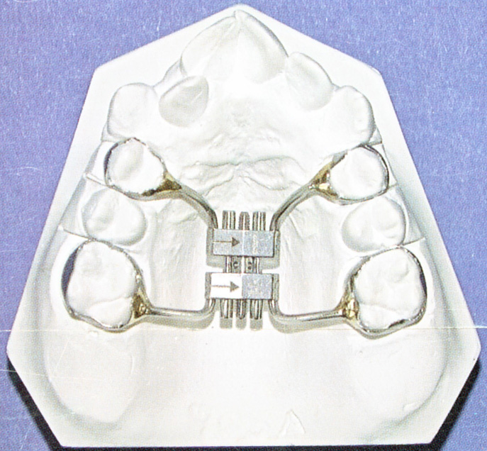 JBC and Company AA629/11 VELTRI Bilateral Sagittal RPE SCREW